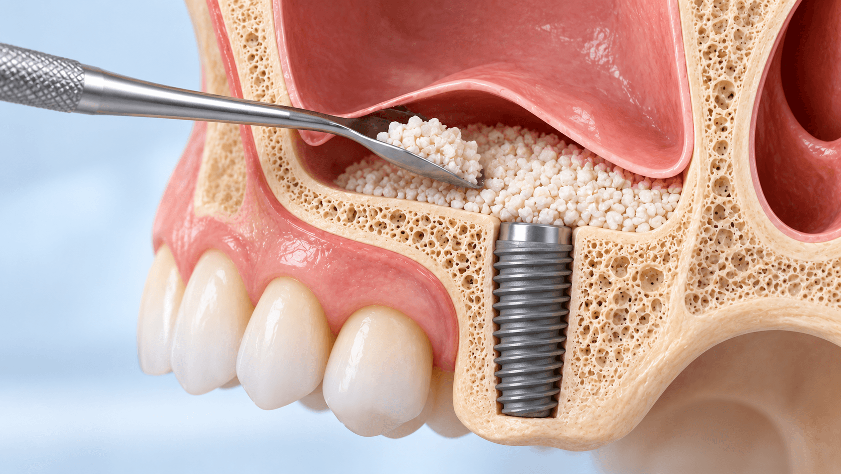 Sinus Lift and Bone Grafting in Implant Dentistry: Indications, Techniques and Complications