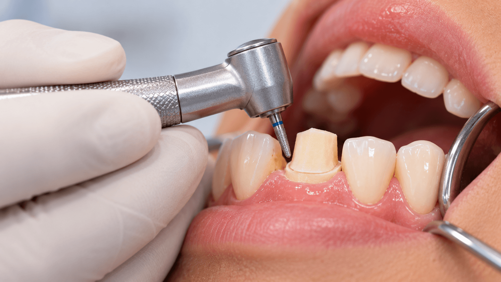 Tooth Preparation for Crowns: Finish Lines, Reduction and Common Errors