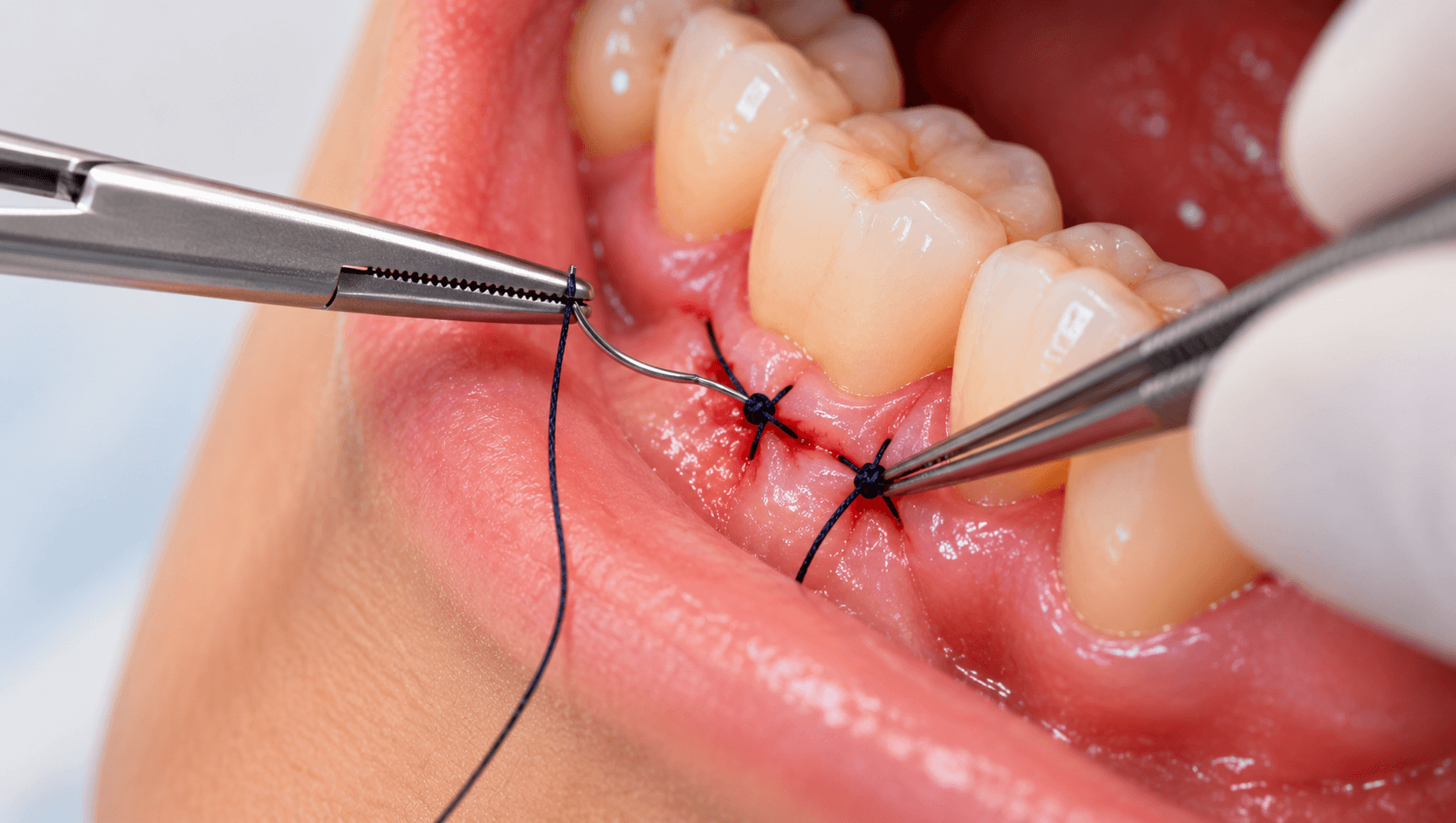 Suturing Techniques in Dentistry: Materials, Needles and Knot Selection